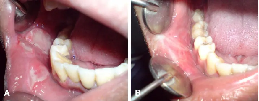 Gambar 2.Tampakan intra oral kunjungan kedua,ulser pada mukosa labial kanan bawah sudahsembuh dan membentuk sikatrik, ulser mukosabukal kanan menjadi lebih kecil.