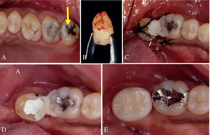 Gambar 3. Prosedur umum transplantasi gigi.Tanne K. Tooth transplantation: the current status and the future development with acryopreservation technique for teeth banking