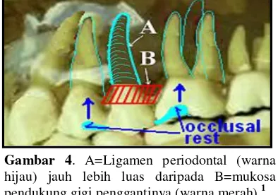 Gambar 5. A=Luas mukosa pada lingir alveolarsesuai dengan luas tempat gigi yang sudah dicabut(diberi warna hitam)