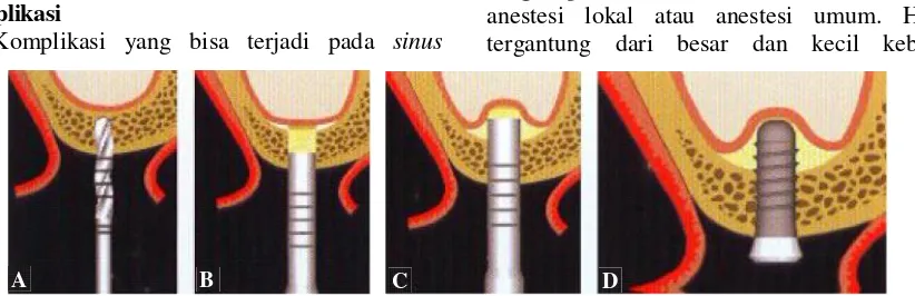 Gambar 3.manuver A.Instrumen osteotome yang digunakanpada tekniktransalveolar osteotomy.B.Valsava (blow test) (Sumber: Pjetursson BI, LangNP