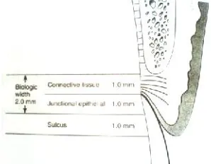 Gambar 1ata puncak gingiva: 1 mm; p; perlekatan epithelial1 mm; kedalaman sulkus gingiva va 1 mm
