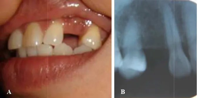 Gambar 1 Foto klinis (Foto klinis (A) dan foto ronsen (B) pasien 1 sebelum perawatanwatan