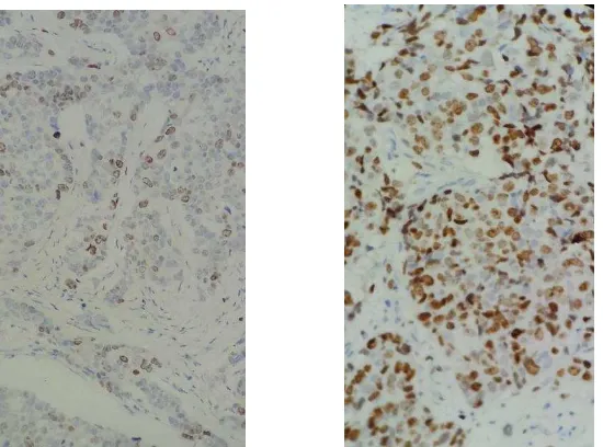 Gambar 2.8  :Imunohistikimia Ki-67 A.Low Proliferasi, B. High Proliferasi (Sumber : Laboratorium Patologi Anatomi RSUP H