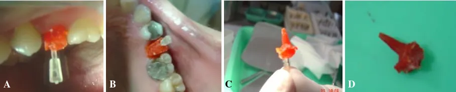 Gambar 1 Kondisi awal gigi pasien; A aspek bukal, B aspek palatinal
