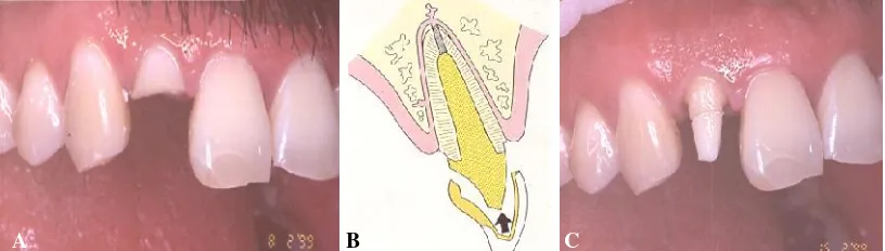 Gambar 1 Gigi insisivus latepasak dan inti, C intilateralis, A fraktur 2/3 mahkota, B dengan restorasi mahahkota penuh dengan