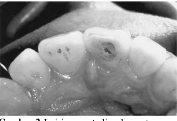 Gambar 2 Insisivus sentralis rahang atas yangmahkotanya tetap utuh, sehingga memerlukanrestorasi pasca perawatan endodontik secarakonservatif dengan komposit.
