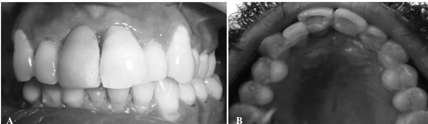 Gambar 6A Penempatan pontik gigi alami pada regio 11, B pontik gigi alami yang distabilkan denganmenggunakan resin fiber reinforced composite (Sumber: Parolia A, Shenoy KM, Thomas MS, Mohan M