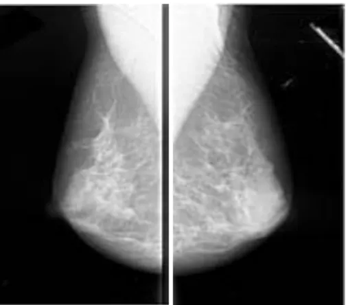 Gambar    2.2  menunjukkan  bahwa  payudara  sebelah  kiri  (yang  diberi  lingkaran  merah)  mengidentifikasikan adanya benjolan dan berdasarkan hasil pemeriksaan dokter ahli, citra  di bawah ini termasuk ke dalam kelompok kasus tumor payudara jinak