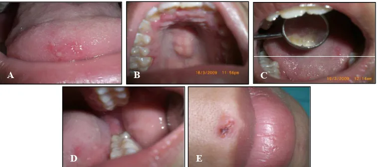 Gambar 1 Kunjungan I, tampak lesi pada A anterior lidah, B palatum regio molar dan garis tengah palatal di daerah rugae palatina, C dorsum lidah, D peradangan pada gingiva molar ketiga, E vesikula di daerah perioral.