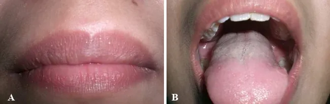 Gambar 2 Kontrol I; A lesi labial telah sembuh, B lesi di lidah telah sembuh.