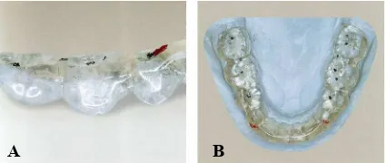 Gambar 8 Desain oklusal;p.306)yang simetris pada regio premolar menjamin disoklusi gigi posterior layaknya mandibula diarahkan oleh permukaan gigi ke posterior di luar interkuspasiterapeutik dari splin, dikunci dengan interkuspasi maksimal splin, yang beba