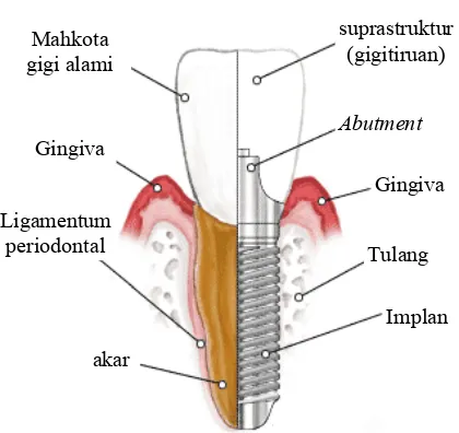 Gambar 1 Perbandingan implan dental dengan gigi alami dan bagian-bagiannya