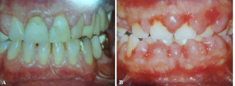 Gambar 2 Pembesaran gingiva karena siklosporin (Sumber: Rateitschak KH, Wolf HF. Color atlas of dental medicine periodontology