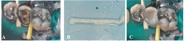 Gambar 8A Gigi 15 fraktur tonjol palatal, etsa asam (Sumber: Deliperi S, Bardwell DN, Coiana C