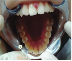 Figure 3  Anesthesia in the teeth 11 and 21 labial part