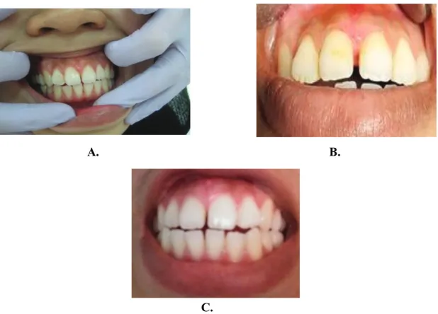 Figure 12  Clinical evalution pasca gingivectomy; A. 1 week control,   B. 2 weeks control, C