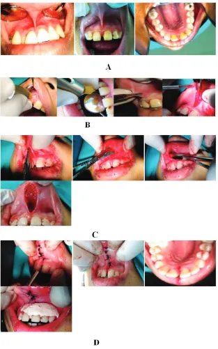Figure 2A. Clinical features before management, labial view, palatal view;
