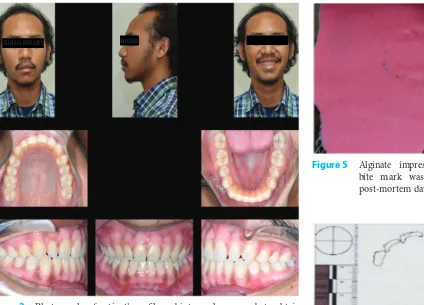 Figure 2  Photographs of patient’s profile and intraoral were made to obtain antemortem data