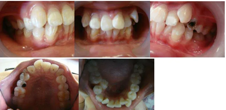 Gambar 1 . Foto intra oral sebelum perawatan. Gigi berjejal berat dan terdapat karies 