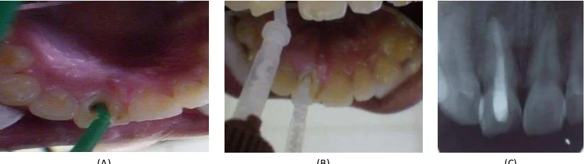 Gambar 7.  (A) Hasil pembentukan kembali gigi 11 menggunakan malam merah (palatal) dan dilakukan pemeriksaan oklusi (B)
