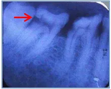 Gambar 1. Foto klinis gigi 47 sebelum perawatan                       Gambar 2.