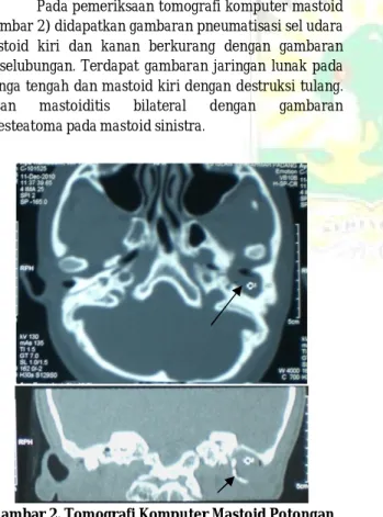 Gambar 2. Tomografi Komputer Mastoid Potongan  Aksial dan Koronal 