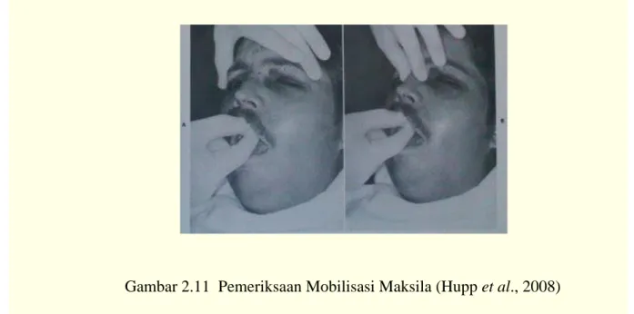 Gambar 2.11  Pemeriksaan Mobilisasi Maksila (Hupp et al., 2008)