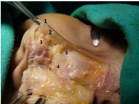 Gambar 6. Piramid hidung. 1.Os nasal, 2.Overlap kartilago lateral atas dengan os  nasal, 3.Kartilago lateral atas, 4.Kartilago lateral bawah krus lateral, 5
