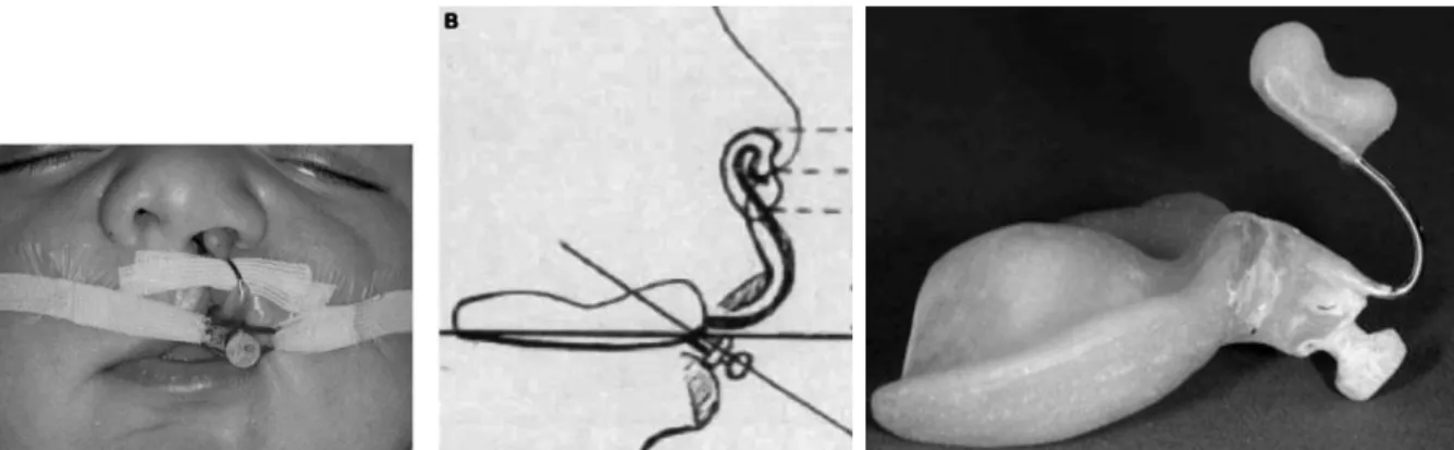 Gambar 3.A.Posisi unilateral nasal stent dengan lip tapping, B.Posisi lengan retentif 40° terhadap bidang horisontal  untuk mendapatkan kestabilan alat, C