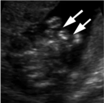 Gambar 12. Cleft lip bilateral pada fetus usia 18 minggu 