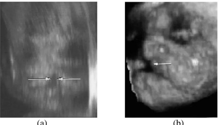 Gambar 13. USG 3-dimensi memperlihatkan adanya facial cleft pada fetus usia 22 minggu(a)  dan facial cleft pada usia kehamilan 32 minggu 