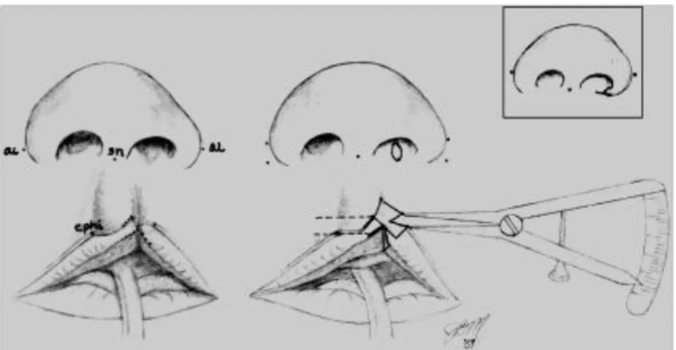 Gambar 14.Titik-titik anatomi Cornu-vermilion-mukosa (Kiri). Desain dua segitiga isosceles  lateral (Cornu dan vermilion) (kanan) 