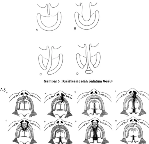 Gambar 6 :  asifikasi celah p Stark (gambar  mplit unilateral  plit kiri palatum foramen insisivu mplit bilateral  mplit dari palat plit dari palatum plit kiri dari pala kunder   mplit bilateral 