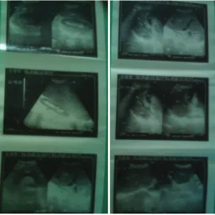 Gambar 1   a. Foto thoraks;  b. Foto BoF 