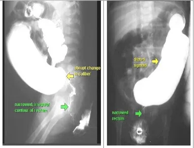 Gambar 3. Terlihat gambar barium enema penderitaHirschsprung. Tampak 