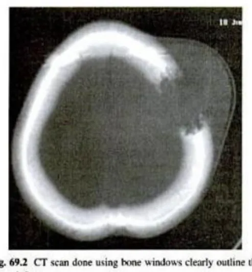 Gambar 4. CT scan skull defect 2) Foto polos kepala (X-ray)
