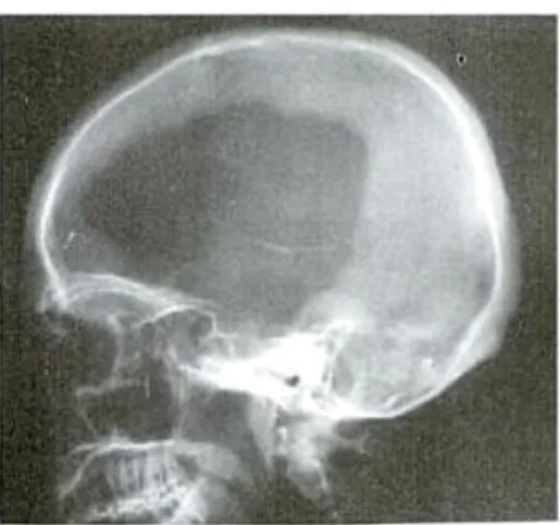 Gambar 5. X-ray skull defect 3) MRI (Magnetik Resonance Imaging)