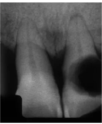 Figure 1. Diagnose of pulp necrosis in the 21st tooth