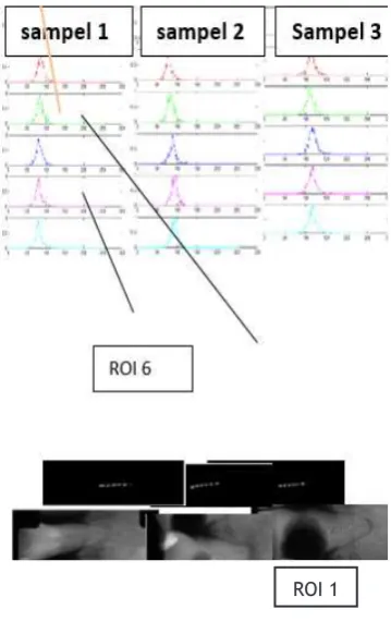 Figure 5. Tooth histogram prior to extraction