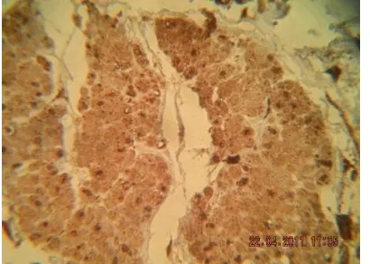 Gambar 1. Kasus karsinoma duktus invasif grade 1. Dengan IHC Cathepsin D menunjukkan tampilan lemah