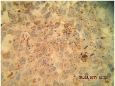 Gambar 4. Kasus karsinoma duktus invasif grade 3. Dengan IHC Cathepsin D menunjukkan tampilan lemah