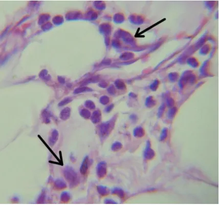 Gambar 2. Tanda panah menunjuk pada makrofag  yang mengekspresi TGF-β, obj. 400x  