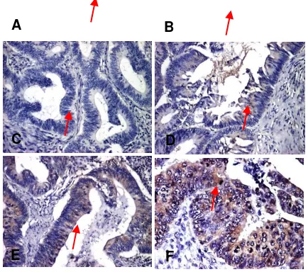Gambar 1. Pewarnaan Imunohistokimia. A. LVD peri-tumoral. B. ILV. C. NM23-H1 pewarnaan kuat