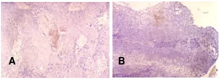 Gambar 1. A. Tampilan antibodi terhadap HPV positif kuat (x20) pada bagian atas permukaan epitel karsi-noma sel skuamous; B