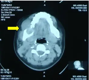 Gambar 1. CT scanbone  expansionkontras diperoleh kesan massa medula dengan  kepala potongan axial tanpa slight   corpus  mandibula  dekstra  suspek malignansi (panah)