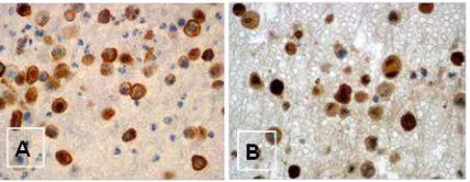 Gambar 3. A. Gambaran mikroskopis FNAB dengan pulasan Diff-quik dan B. Pulasan Hematoksilin-Eosin (HE) dari gambaran mikroskopik cell block