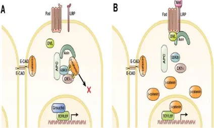 Gambar 2. A. KSSO derajat tinggi dengan skor Bryne 15; B. Pewarnaan IHK menunjukkan ekspresi β-katenin pada sitoplasma dan inti, namun tidak tampak ekspresi pada membran sel; C