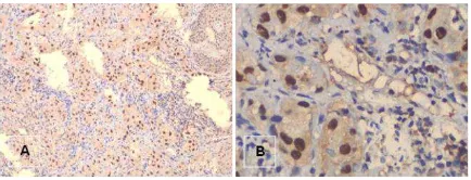 Gambar 4. Karsinoma sel squamosa. A. IHC p53, 100x; B. IHC p53, 400x. 