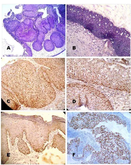 Gambar A. Varian inverted papilloma dengan pewar-