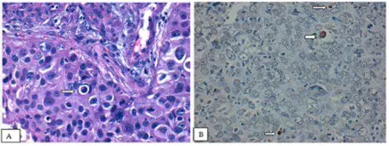 Gambar 1. Sel apoptotik pada sediaan HE (400x) karsinoma medular dengan sitoplasma yang padat (tanda panah) (A) Sel yang apoptosis berwarna coklat (tanda panah) dengan pewarnaan TUNEL (B)
